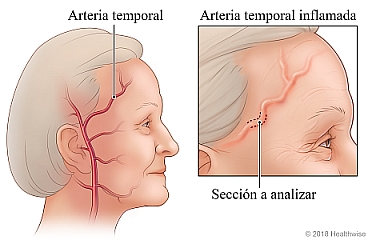 Arteria temporal con detalle de la sección de la arteria de la cual se tomará una muestra