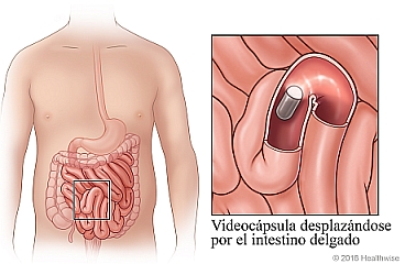 El intestino delgado, con detalle de la videocápsula desplazándose por su interior