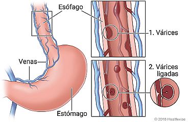 Esófago y estómago, con detalle de várices en las venas con bandas y sin ellas