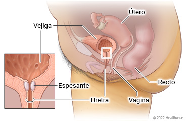 Vista lateral interna de los órganos pélvicos femeninos, incluidos el útero, la vejiga, la uretra, la vagina y el recto, con detalles que muestran el espesante alrededor de la uretra cerca de la vejiga.