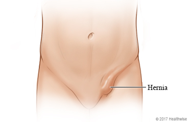 Ubicación de una hernia inguinal