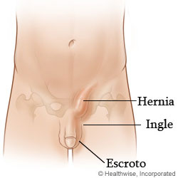 Imagen de una hernia inguinal