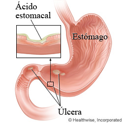 Imagen de úlceras en el estómago