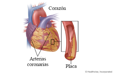 Arterias coronarias, con detalle de placa en una arteria