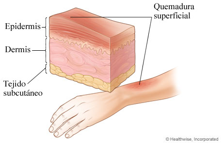 Quemadura de primer grado: quemadura superficial