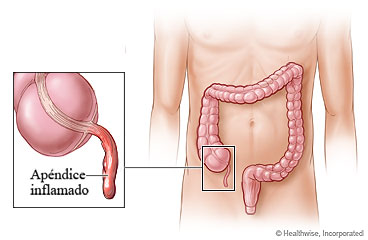 Apéndice inflamado