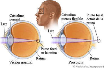 Ojos con visión normal y presbicia