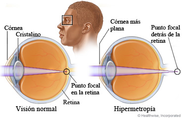 Anatomía del ojo y muestra de la hipermetropía