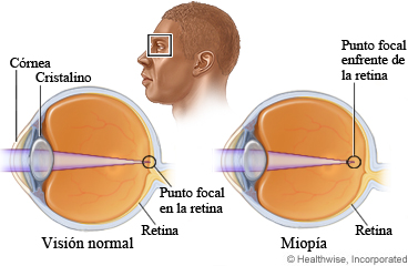 Imagen de los ojos que muestra la visión normal y la miopía