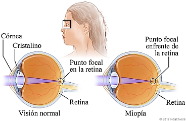 Secciones transversales del ojo con visión normal y ojo con miopía