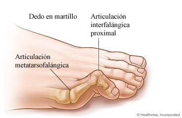 Dedo del pie en martillo