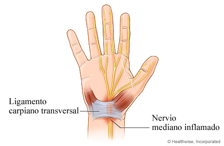 Nervio mediano inflamado en el síndrome del túnel carpiano.