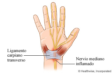 Nervio y ligamento de la mano con síndrome del túnel carpiano