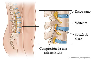 Nervio comprimido