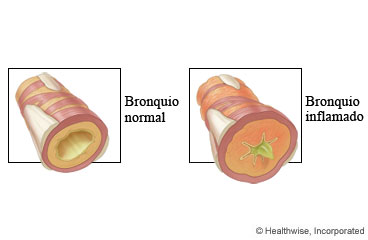 Bronquios normales e inflamados