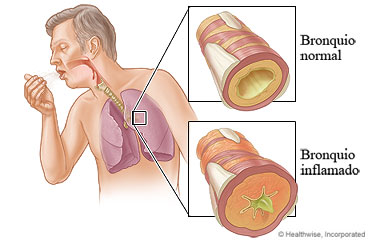 Imagen de los pulmones y un bronquio inflamado