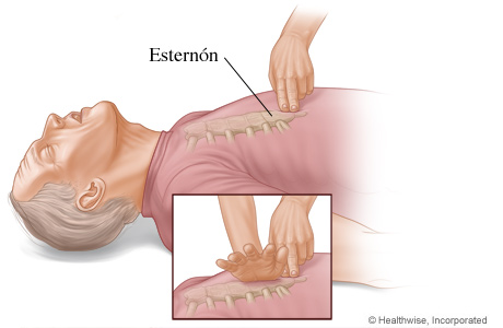Imagen de dónde colocar las manos en el esternón para compresiones de pecho