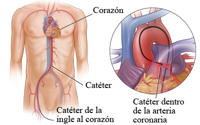 Cateterismo cardíaco