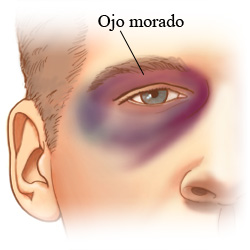 Imagen de un ojo morado