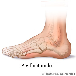 Pie fracturado