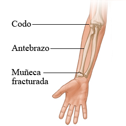 Los huesos del brazo y una fractura de muñeca