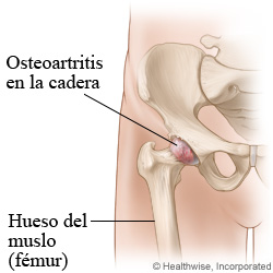 Ilustración de osteoartritis de la cadera