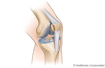 Enfermedad de Osgood-Schlatter