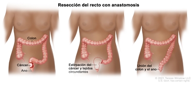 La ilustración a tres paneles muestra una cirugía de cáncer de recto con anastomosis; el primer panel muestra el área del recto con cáncer, el panel medio muestra la extracción del cáncer y el tejido circundante, el último panel muestra la unión del colon y el ano.