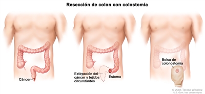 La ilustración a tres paneles muestra una cirugía de cáncer de ano con colostomía; el primer panel muestra el área del ano con cáncer, el panel del medio muestra la extirpación del cáncer y el tejido circundante y la creación de un estoma, el último panel muestra la colocación de la bolsa de colostomía junto al estoma.