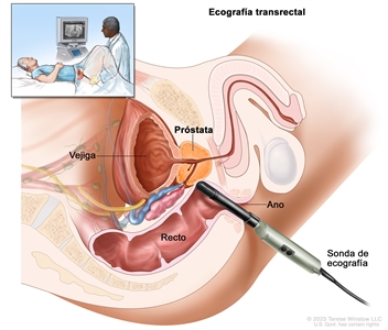 Ecografía transrectal. En el dibujo se observa una vista lateral de la anatomía del aparato reproductor y del aparato urinario masculinos, incluso la vejiga y la próstata. Además, se muestra el recto y el ano. También se observa una sonda de ecografía que se introduce en el recto para examinar la próstata. En un recuadro, se muestra a un proveedor de atención de la salud que introduce la sonda de ecografía en el recto del paciente mientras observa una imagen de la ecografía en la pantalla de la computadora. El paciente está acostado boca arriba en una camilla.