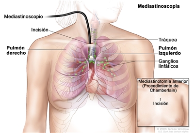 Mediastinoscopia. En la imagen se observa un mediastinoscopio con una lente y una luz. El mediastinoscopio se introduce en el tórax a través de una incisión por encima del esternón. Se observan el pulmón derecho e izquierdo, la tráquea y los ganglios linfáticos. En el recuadro se muestra una mediastinotomía (procedimiento de Chamberlain).