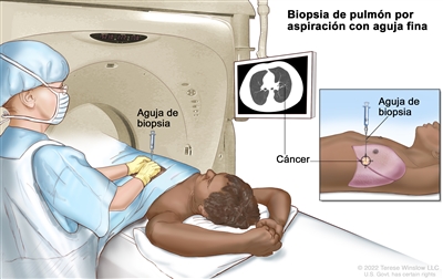 Biopsia de pulmón por aspiración con aguja fina; en la imagen se muestra a un paciente acostado sobre una camilla que se desliza a través de una máquina de tomografía computarizada (TC), y una radiografía de un corte transversal del pulmón en un monitor arriba del paciente. En la imagen también se muestra a un médico usando la radiografía para ayudarlo a colocar la aguja de biopsia a través de la pared torácica, hasta el área del tejido anormal del pulmón. En el recuadro se muestra una vista lateral de la cavidad torácica y los pulmones con la aguja de biopsia insertada en el área de tejido anormal.