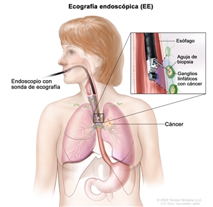 Biopsia por aspiración con aguja fina guiada mediante ecografía endoscópica. En la imagen se muestra un endoscopio con una sonda de ecografía y una aguja de biopsia que se introduce por la boca hasta el esófago. También se observan los ganglios linfáticos cerca del esófago y cáncer en un pulmón. En un recuadro se muestra la identificación de los ganglios linfáticos con cáncer mediante la sonda ecográfica y la extracción de tejido de uno de los ganglios linfáticos cercanos al esófago con la aguja de biopsia.