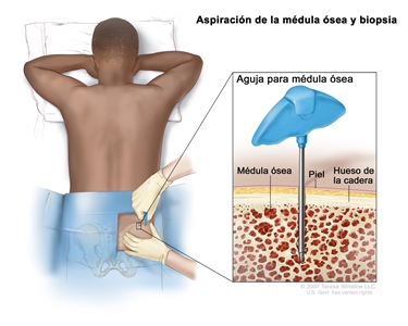 Aspiración de la médula ósea y biopsia; el dibujo muestra a un paciente acostado boca abajo en una camilla y una aguja para médula ósea que se inserta en el hueso de la cadera. El recuadro muestra la aguja para médula ósea que se inserta a través de la piel hasta la médula ósea del hueso de la cadera.