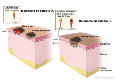 Dibujo de dos paneles del melanoma en estadio I. En el panel de la izquierda se observa un tumor en estadio IA que no mide más de 1 mm de grosor, y hay ulceración (rotura de la piel) o no hay ulceración. En el panel de la derecha se observa un tumor en estadio IB que mide más de 1 mm pero no más de 2 mm y no hay ulceración. También se muestran la epidermis (capa superficial o externa de la piel), la dermis (capa profunda o interna de la piel) y el tejido subcutáneo debajo de la dermis.