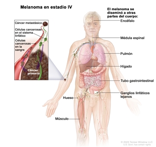 Melanoma en estadio IV. En el dibujo se observan otras partes del cuerpo donde es posible que se disemine el melanoma, como el encéfalo, la médula espinal, el pulmón, el hígado, el tubo gastrointestinal, el hueso, el músculo y los ganglios linfáticos lejanos. En un recuadro se muestran células cancerosas que se diseminan a través de la sangre y el sistema linfático a otra parte del cuerpo donde se formó un tumor metastásico.