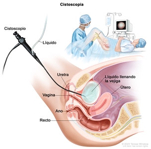 Cistoscopia. En la imagen se muestra una vista lateral de la pelvis inferior donde se encuentran la vejiga, el útero, la vagina, el recto y el ano. Se muestra un cistoscopio (instrumento delgado en forma de tubo, con una luz y una lente para observar) que pasa a través de la uretra hasta la vejiga. Se usa un líquido para llenar la vejiga. En el recuadro se observa a una mujer con una sábana, acostada en una camilla con las rodillas dobladas y las piernas separadas. El médico observa una imagen de la pared interna de la vejiga en el monitor de una computadora para verificar si hay áreas anormales.