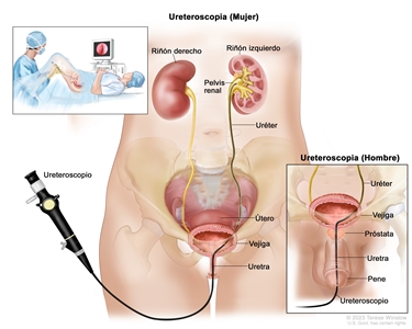 Se muestra un dibujo de una ureteroscopia en una mujer, en la que se observa la pelvis inferior y se señalan los riñones derecho e izquierdo, la pelvis renal, el uréter, el útero, la vejiga, y la uretra. Así mismo, se muestra un dibujo de una ureteroscopia en un hombre en la que se observa la pelvis inferior y se señalan el uréter, la vejiga, la próstata, la uretra y el pene. En ambos dibujos se ve un ureteroscopio (instrumento delgado en forma de tubo con una luz y una lente para observar) que pasa a través de la uretra hacia la vejiga y el uréter. En la figura de la mujer el ureteroscopio también se introduce en la pelvis renal. Además, hay un recuadro en el que se observa a una persona acostada en una camilla con las rodillas flexionadas y las piernas separadas, cubiertas por una sábana, y un médico que mira una imagen del interior del uréter o la pelvis renal en el monitor de unacomputadora.