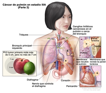 Cáncer de pulmón en estadio IIIA (Parte 2). En la imagen se observa lo siguiente: a) un tumor primario que mide más de 5 cm, pero no más de 7 cm en el pulmón izquierdo y ganglios linfáticos cancerosos en el pulmón o cerca del bronquio del mismo lado del tórax que el tumor primario; b) tumores separados en el mismo lóbulo del pulmón que el tumor primario; c) el cáncer se diseminó a la pared torácica, así como a la membrana que recubre el pulmón y la membrana que reviste la pared torácica (recuadro superior izquierdo); d) el cáncer se diseminó al nervio que controla el diafragma; e) el cáncer se diseminó al pericardio (recuadro inferior izquierdo). También se muestran la tráquea, el bronquio principal izquierdo, el diafragma, el corazón y, en el recuadro superior derecho, una costilla.