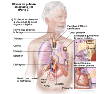 Cáncer de pulmón en estadio IIIB (Parte 2). En la imagen se observa un tumor primario en el pulmón izquierdo y a) un tumor separado en otro lóbulo del pulmón con el tumor primario. También se muestran ganglios linfáticos cancerosos del mismo lado del tórax que el tumor primario. Los ganglios linfáticos cancerosos están alrededor de la tráquea o donde la tráquea se divide para formar los bronquios. También se observa que el cáncer se diseminó a los siguientes sitios: la pared torácica y la membrana que reviste el interior de la pared torácica, el nervio que controla la laringe, la tráquea, la carina, el esófago, el esternón, el diafragma, el nervio que controla el diafragma, la aorta, la vena cava, el corazón y el pericardio (membrana que rodea el corazón).