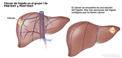 Cáncer de hígado en el grupo I de PRETEXT y POSTTEXT. En la imagen se observan 2 hígados. Las líneas punteadas dividen cada hígado en 4 secciones verticales de casi el mismo tamaño. En el primer hígado, el cáncer se encuentra en la sección extrema izquierda. En el segundo hígado, el cáncer se encuentra en la sección extrema derecha.