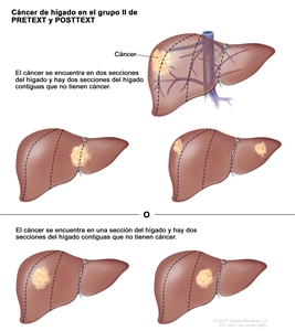 Cáncer de hígado en el grupo II de PRETEXT y POSTTEXT. En la imagen se observan 5 hígados. Las líneas punteadas dividen cada hígado en 4 secciones verticales de casi el mismo tamaño. En el primer hígado, el cáncer se encuentra en las 2 secciones de la izquierda. En el segundo hígado, el cáncer se encuentra en las 2 secciones de la derecha. En el tercer hígado, el cáncer se encuentra en la sección extrema izquierda y en la sección extrema derecha. En el cuarto hígado, el cáncer se encuentra en la segunda sección desde la izquierda. En el quinto hígado, el cáncer se encuentra en la segunda sección desde la derecha.