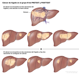 Cáncer de hígado en el grupo III de PRETEXT y POSTTEXT. En la imagen se observan 7 hígados. Las líneas punteadas dividen cada hígado en 4 secciones verticales de casi el mismo tamaño. En el primer hígado, el cáncer se encuentra en 3 secciones de la izquierda. En el segundo hígado, el cáncer se encuentra en las 2 secciones de la izquierda y en la sección extrema derecha. En el tercer hígado, el cáncer se encuentra en la sección extrema izquierda y en las 2 secciones de la derecha. En el cuarto hígado, el cáncer se encuentra en 3 secciones de la derecha. En el quinto hígado, el cáncer se encuentra en las 2 secciones del medio. En el sexto hígado, el cáncer se encuentra en la sección extrema izquierda y en la segunda sección desde la derecha. En el séptimo hígado, el cáncer se encuentra en la sección extrema derecha y en la segunda sección desde la izquierda.