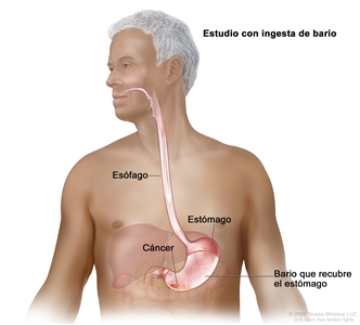 Estudio con ingesta de bario. En el dibujo se observa el tronco y la cabeza de un hombre mayor. Además, se ve bario líquido que pasa por el esófago hasta el estómago. El bario recubre y resalta el interior del esófago y el estómago. También se observa cáncer de estómago.