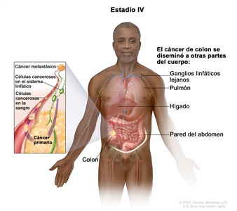 Cáncer de colon en estadio IV. En la imagen se muestran otras partes del cuerpo adonde es posible que el cáncer de colon se disemine, como los ganglios linfáticos lejanos, el pulmón, el hígado y la pared del abdomen. En el recuadro se muestran las células cancerosas que se diseminan desde el colon, a través de la sangre y el sistema linfático, hasta otra parte del cuerpo donde se formó el cáncer metastásico.