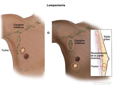 Lumpectomía. En la imagen de la izquierda, se observa un área en la que se extirpará el tumor y un poco del tejido normal que lo rodea. En la imagen de la derecha, se observa un área en la que se extirparán algunos ganglios linfáticos de la axila, y otra área en la que se extirpará el tumor y parte del revestimiento de la pared torácica cercana al tumor. También se muestra el tejido graso de la mama.