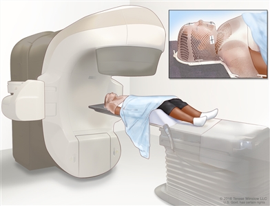 Radioterapia de haz externo de la cabeza y el cuello; el dibujo muestra un paciente acostado sobre una mesa debajo de una máquina que se usa para enfocar radiación de alta energía en el cáncer. El recuadro muestra una máscara de malla que ayuda a inmovilizar la cabeza y el cuello del paciente durante el tratamiento. La máscara tiene pedazos de cinta blanca con pequeñas marcas de tinta. Las marcas de tinta se utilizan para alinear la máquina de radiación en la misma posición antes de cada tratamiento.