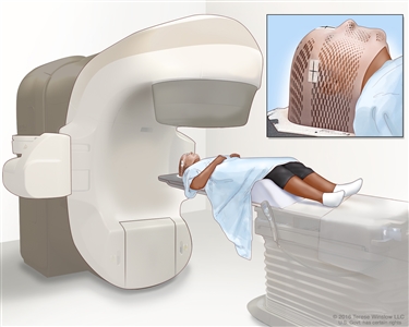 Radioterapia de haz externo del encéfalo; el dibujo muestra un paciente acostado sobre una mesa debajo de una máquina que se usa para enfocar radiación de alta energía. El recuadro muestra una máscara de malla que ayuda a inmovilizar la cabeza del paciente durante el tratamiento. La máscara tiene pedazos de cinta blanca con pequeñas marcas de tinta. Las marcas de tinta se utilizan para alinear la máquina de radiación en la misma posición antes de cada tratamiento.