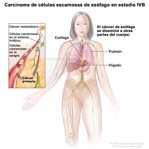 Carcinoma de células escamosas de esófago en estadio IVB. En la imagen se observan otras partes del cuerpo donde se diseminó el cáncer, como el pulmón y el hígado. En un recuadro se muestran células cancerosas que se diseminan desde el esófago, a través de la sangre y el sistema linfático, hasta otra parte del cuerpo donde se formó el cáncer metastásico.