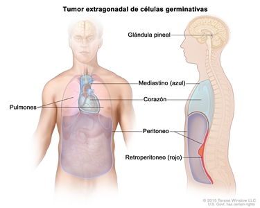 Tumor extragonadal de células germinativas; la imagen muestra las partes del cuerpo donde los tumores de células germinativas se pueden formar, incluso la glándula pineal del cerebro, el mediastino (área entre los pulmones, incluso el corazón) y el retroperitoneo (area detrás del peritoneo). También se muestra el corazón y el peritoneo.